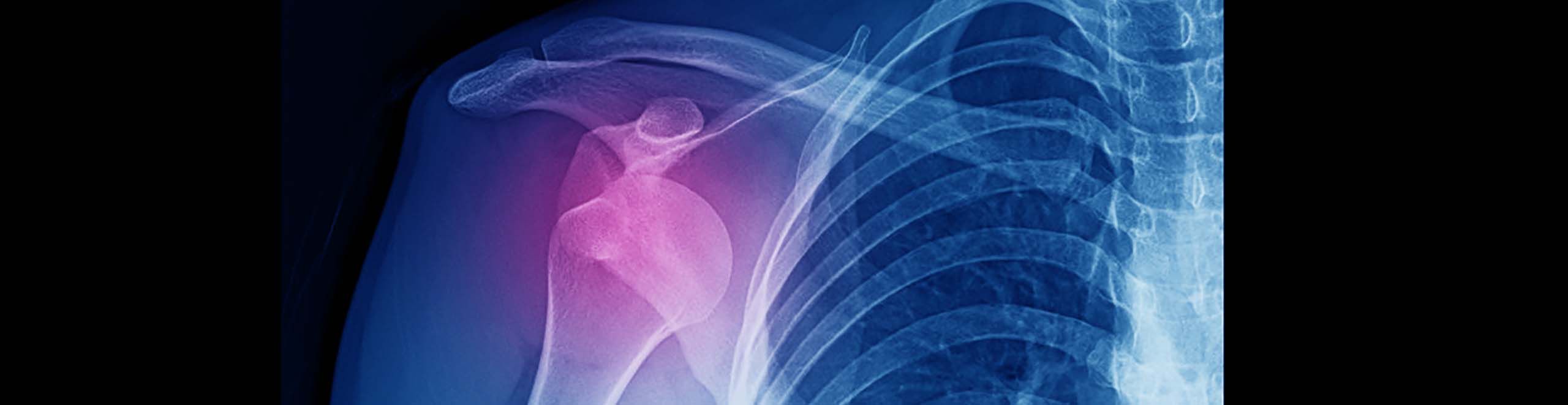 Humeral Head Resurfacing Hemi-Arthroplasty for Osteoarthritis